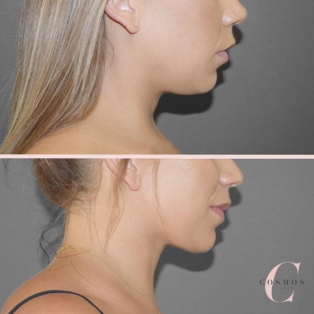 Recent before & after of facial Liposuction