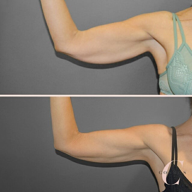 Recent before & after of Liposuction with Renuvion skin tightening technology