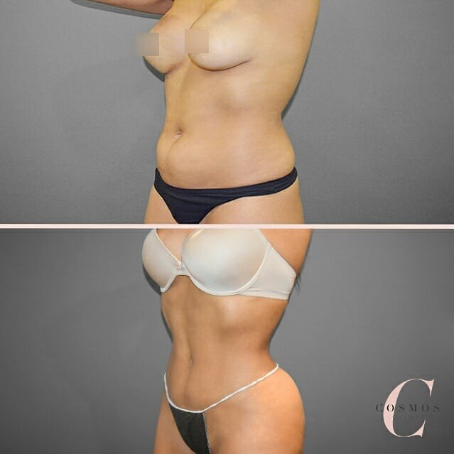 Recent before & after of a patient choosing Liposuction for body contouring