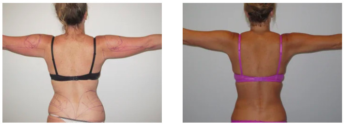 VASER Hi-Definition Arm Liposuction Can Save You Years At The Gym