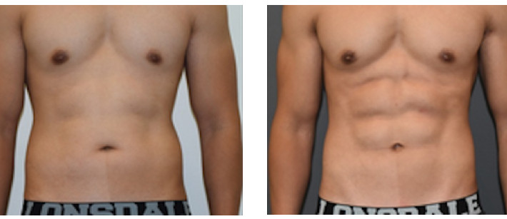 Before & After of male Vaser High Definition Liposuction Surgery via Dr Joseph Ajaka’s Real Self Profile