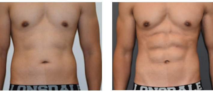 Male Six-Pack Ab Sculpting, 4D VASER Hi-Def Body Sculpting