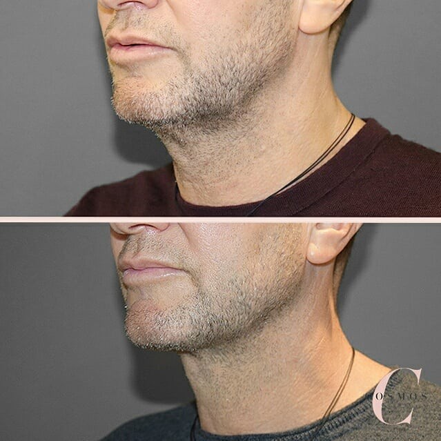 Before and After of Neck Liposuction as seen on our Instagram Feed