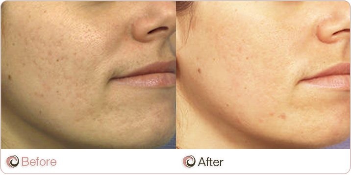 Before and After of acne scarring treatment