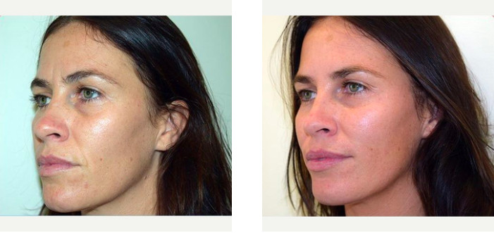 Before & After of wrinkle treatment via Dr Joseph Ajaka's Real Self Profile