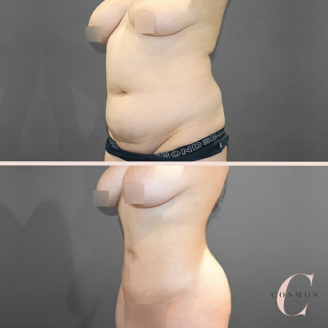 What areas of the body can be treated with liposuction