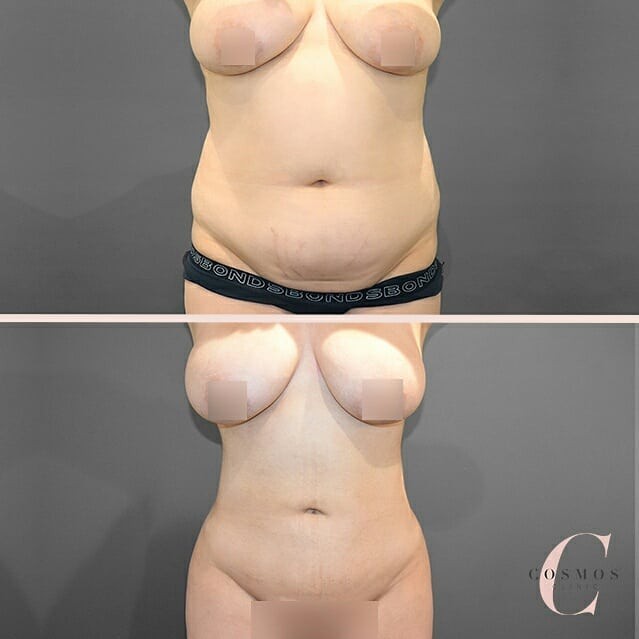 Transforming Body Shape - Liposuction for Targeted Areas