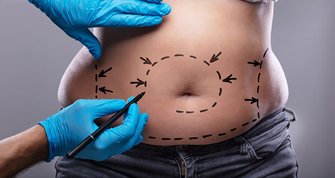 Treating These Areas with Liposuction Can Transform Your Entire Body Shape