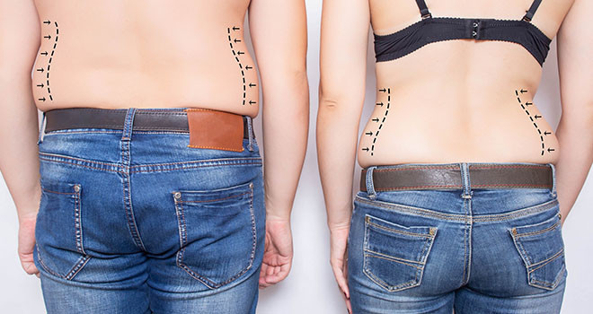 Traditional vs Vaser Liposuction In Adelaide - Cosmos Clinic