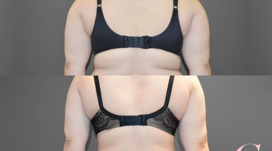 Battling bra fat overhang - the treatment that works - Cosmos Clinic