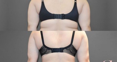 What procedure removes back fat folds, extra skin, bra strap fat etc.?  (Photo)