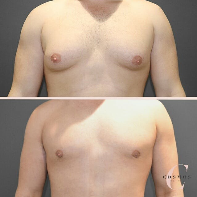 Gynecomastia Surgery (Man Boobs)