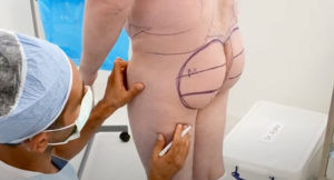 Male BBL procedure at Cosmos Clinic