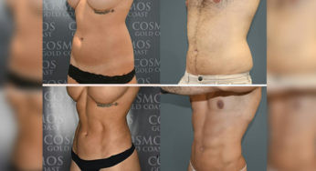 Tampa Liposuction Specialty Clinic