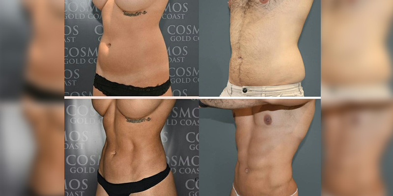 Will You Get Better Looking Abs With A Tummy Tuck?