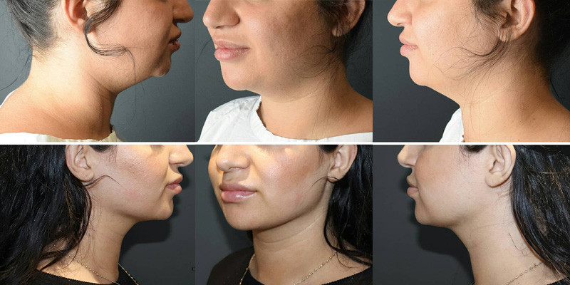 Good Jawline Vs Bad Jawline