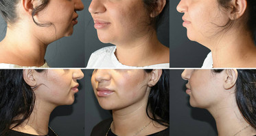 Get A Chiseled Jawline Without Surgery