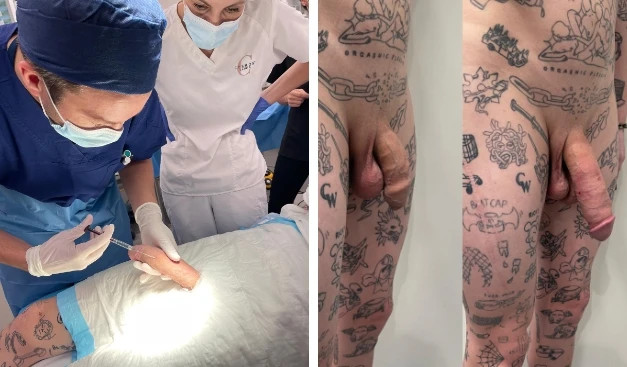 penis filler or penis enlargement injections