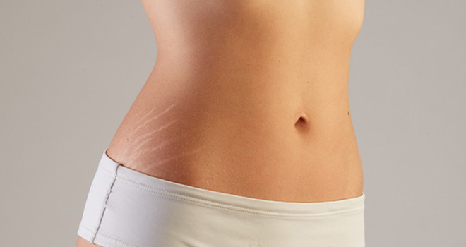 Body jet liposuction at Cosmos Clinic, model 03