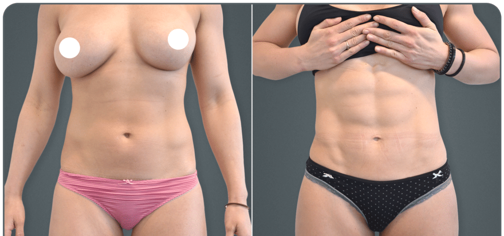 Female Vaser Hi Definition Liposuction