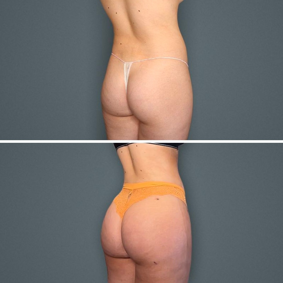 Buttock Augmentation, Brazilian Butt Lift Surgery