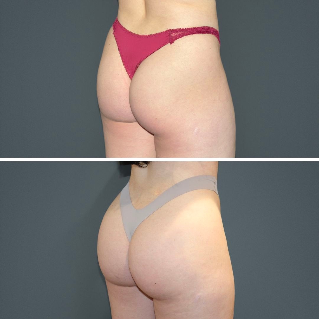 4 week scar update: Buttocks lift / BBL/ liposuction / boob job