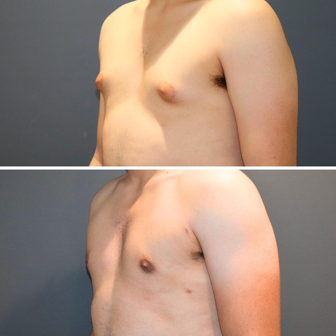Man Boobs Liposuction - Achieve a More Masculine Appearance