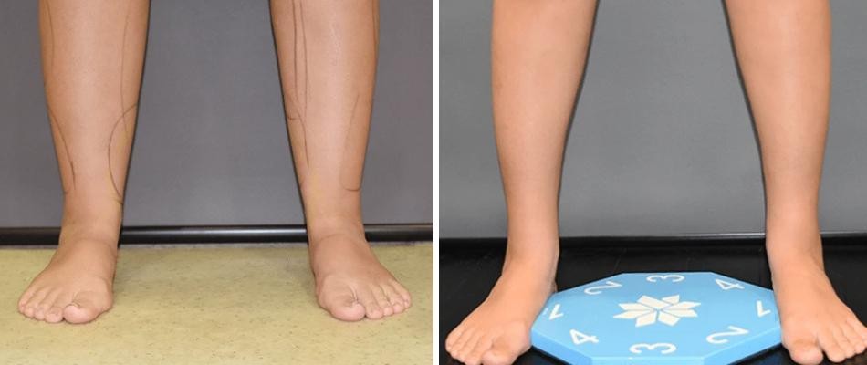 Ankle Calf Ankles Coolsculpting Liposuction Female Pre2024 001 Before And After