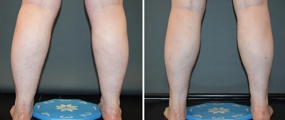 Ankle Calf Coolsculpting Liposuction Female Pre2024 002 Before And After