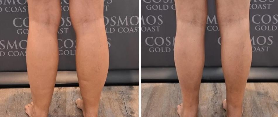 Ankle Calf Liposuction Female Pre2024 004 Before And After