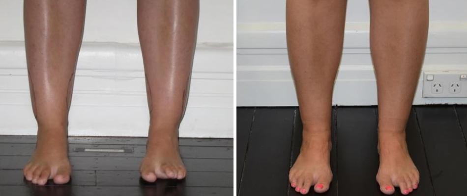 Ankle Calf Liposuction Female Pre2024 006 Before And After
