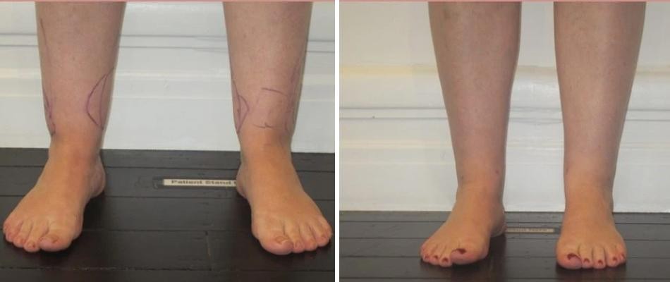 Ankle Calf Liposuction Female Pre2024 007 Before And After