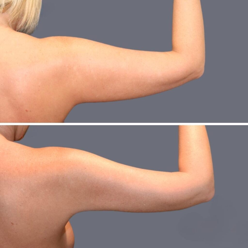 Arm Liposcution Pre2024 001 Before And After