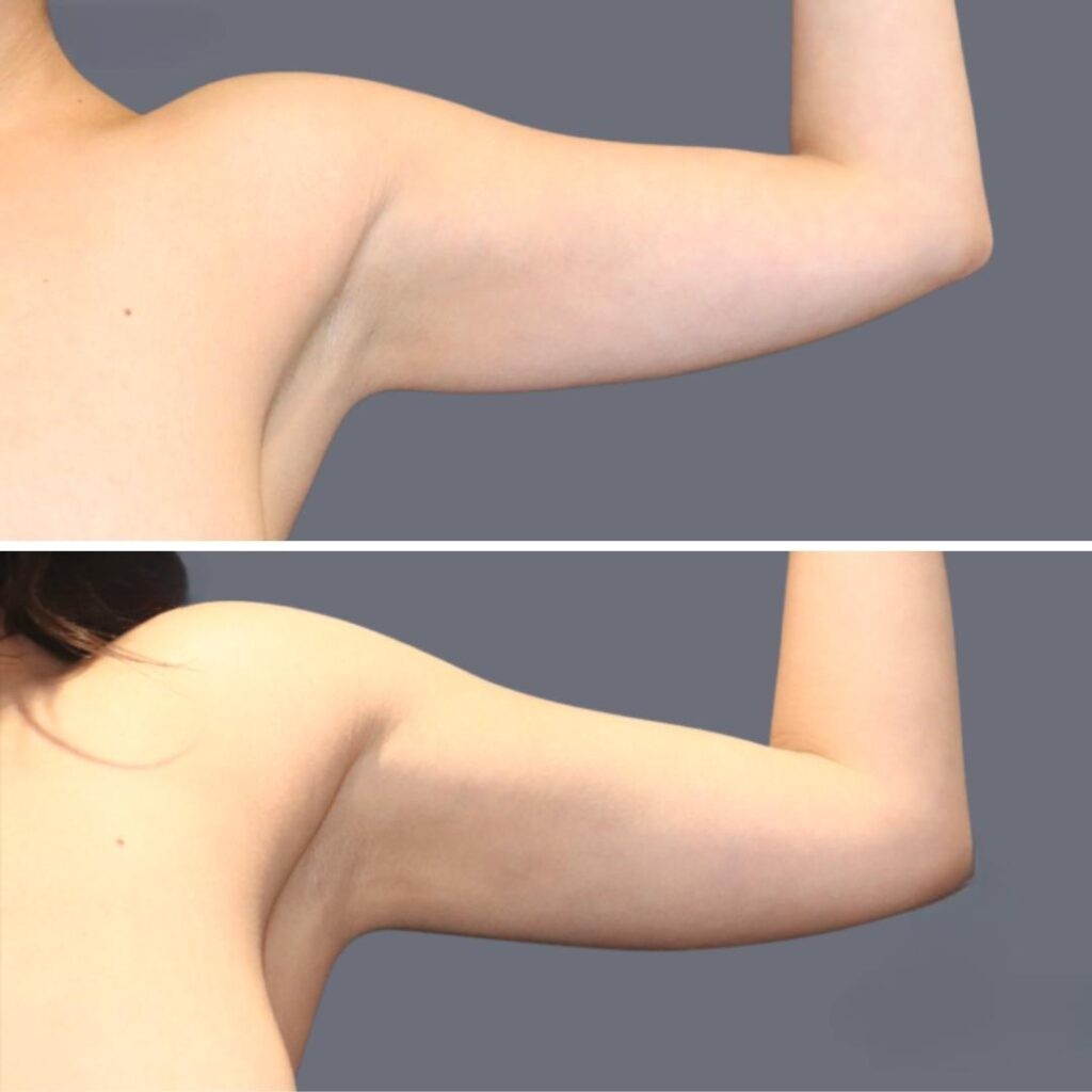 Arm Liposcution Pre2024 002 Before And After