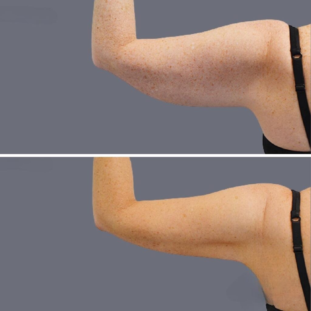 Arm Liposcution Pre2024 003 Before And After