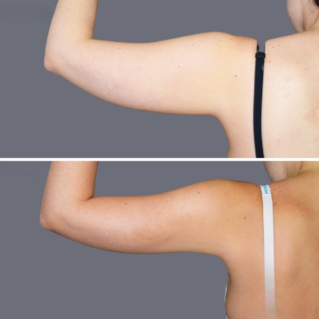 Arm Liposcution Pre2024 004 Before And After