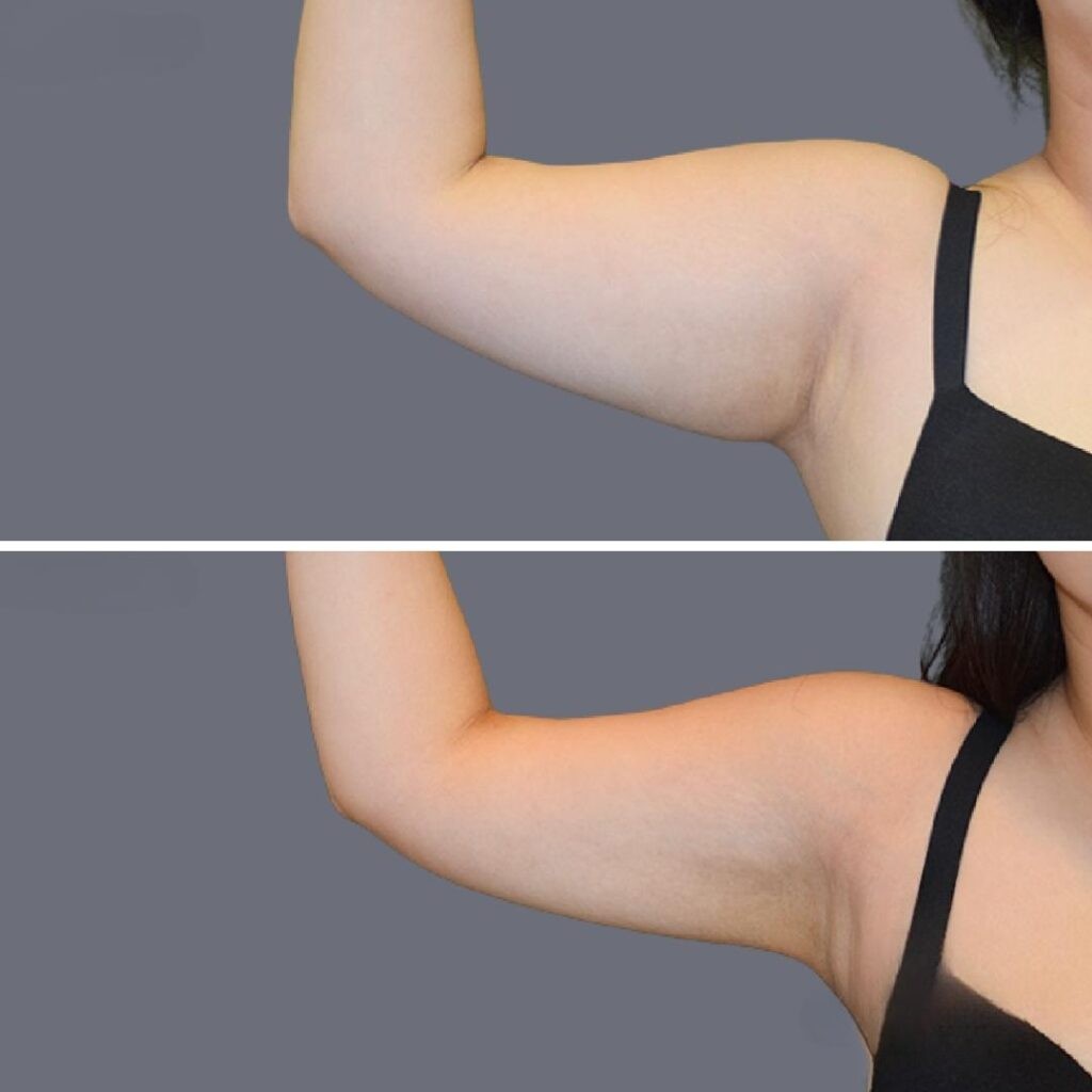Arm Liposcution Pre2024 005 Before And After