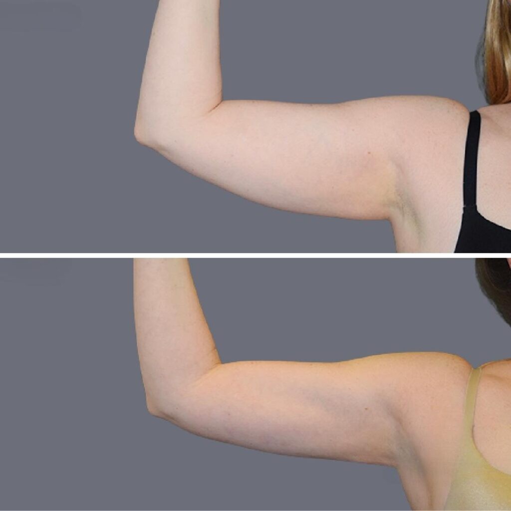 Arm Liposcution Pre2024 006 Before And After