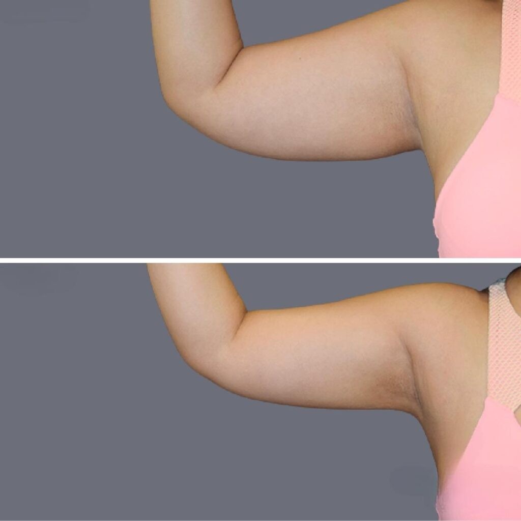 Arm Liposcution Pre2024 007 Before And After