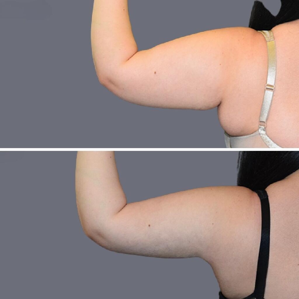Arm Liposcution Pre2024 008 Before And After