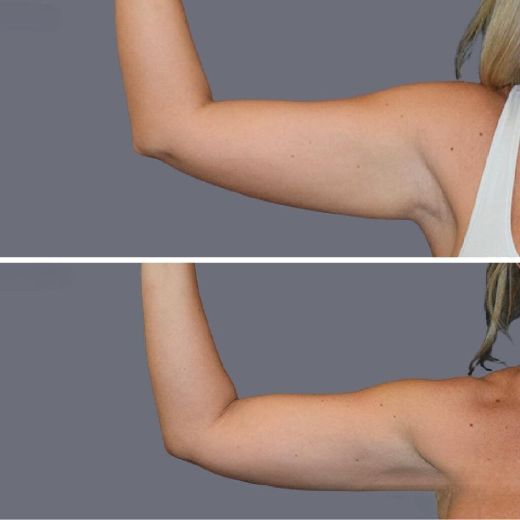 Arm Liposcution Pre2024 009 Before And After
