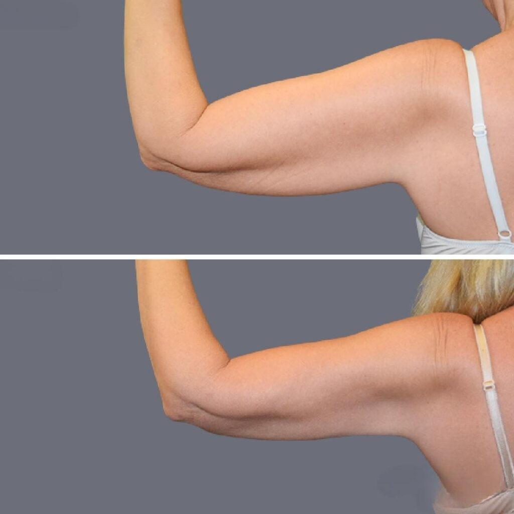 Arm Liposcution Pre2024 010 Before And After
