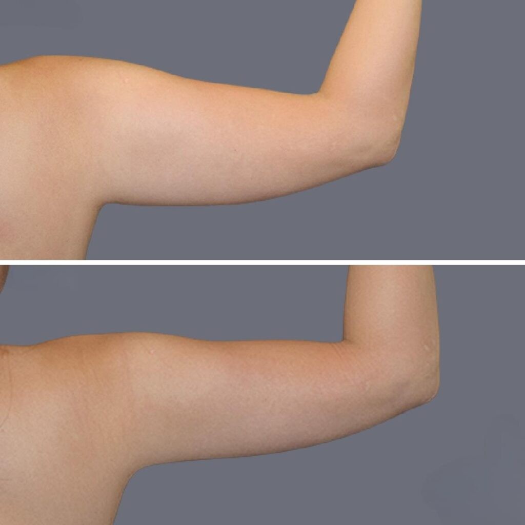 Arm Liposcution Pre2024 011 Before And After