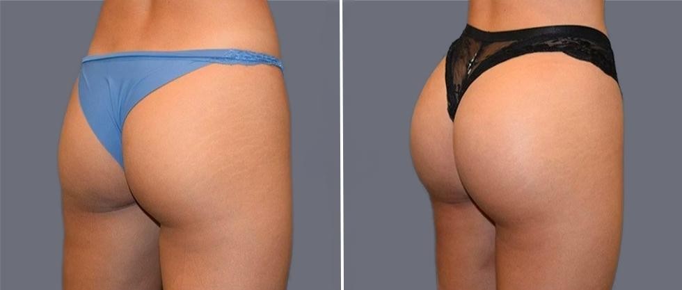 Brazilian Butt Lift Pre2024 001 Before And After