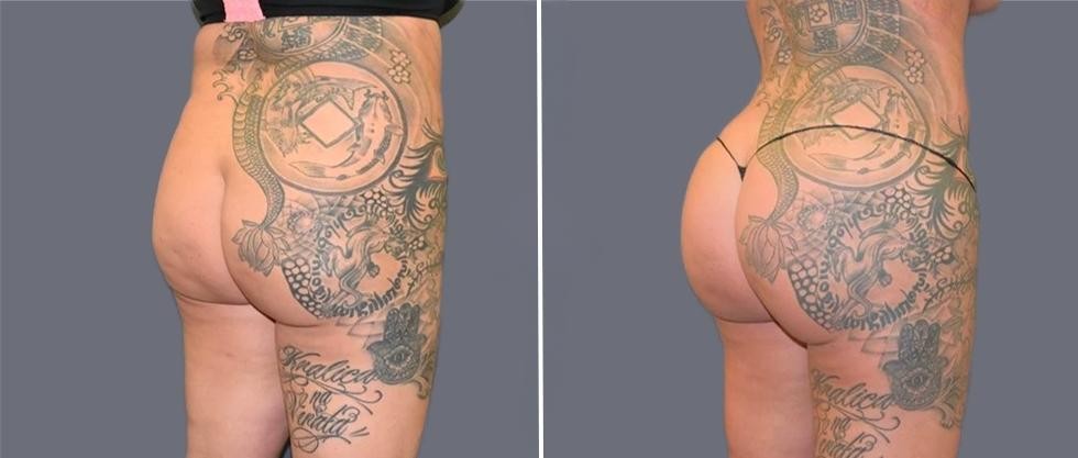 Brazilian Butt Lift Pre2024 002 Before And After