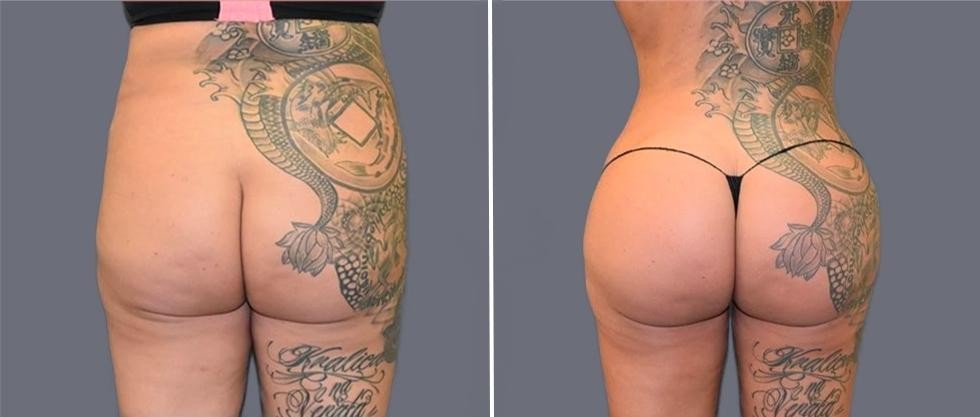 Brazilian Butt Lift Pre2024 003 Before And After