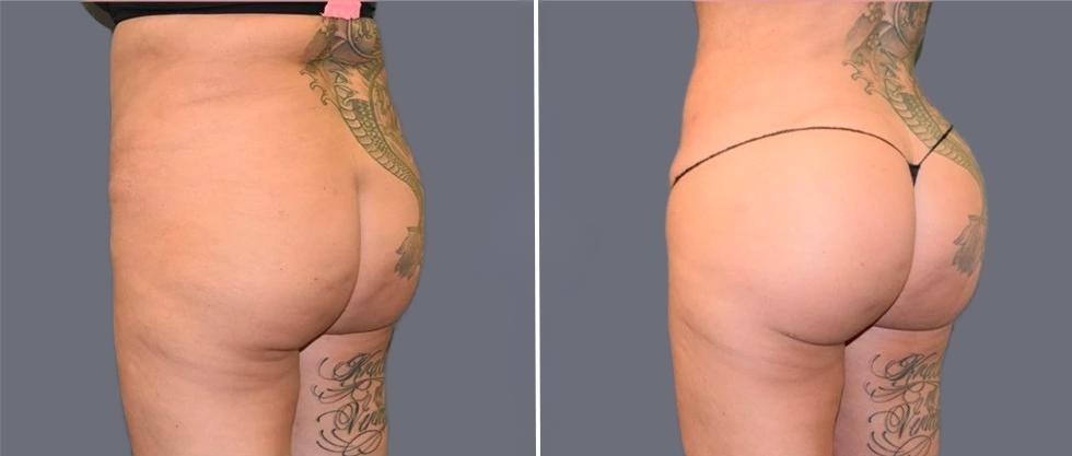 Brazilian Butt Lift Pre2024 004 Before And After