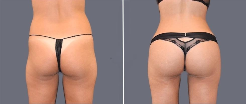 Brazilian Butt Lift Pre2024 005 Before And After