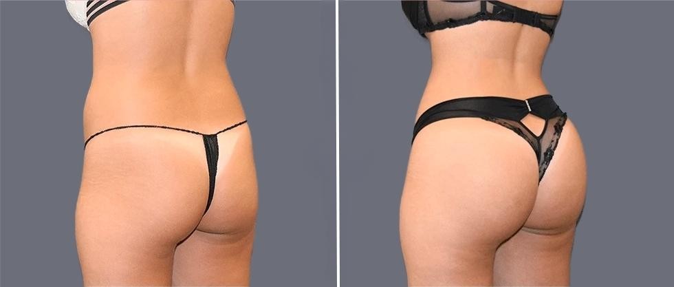 Brazilian Butt Lift Pre2024 006 Before And After