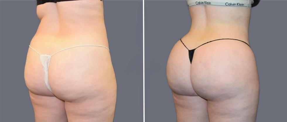 Brazilian Butt Lift Pre2024 007 Before And After